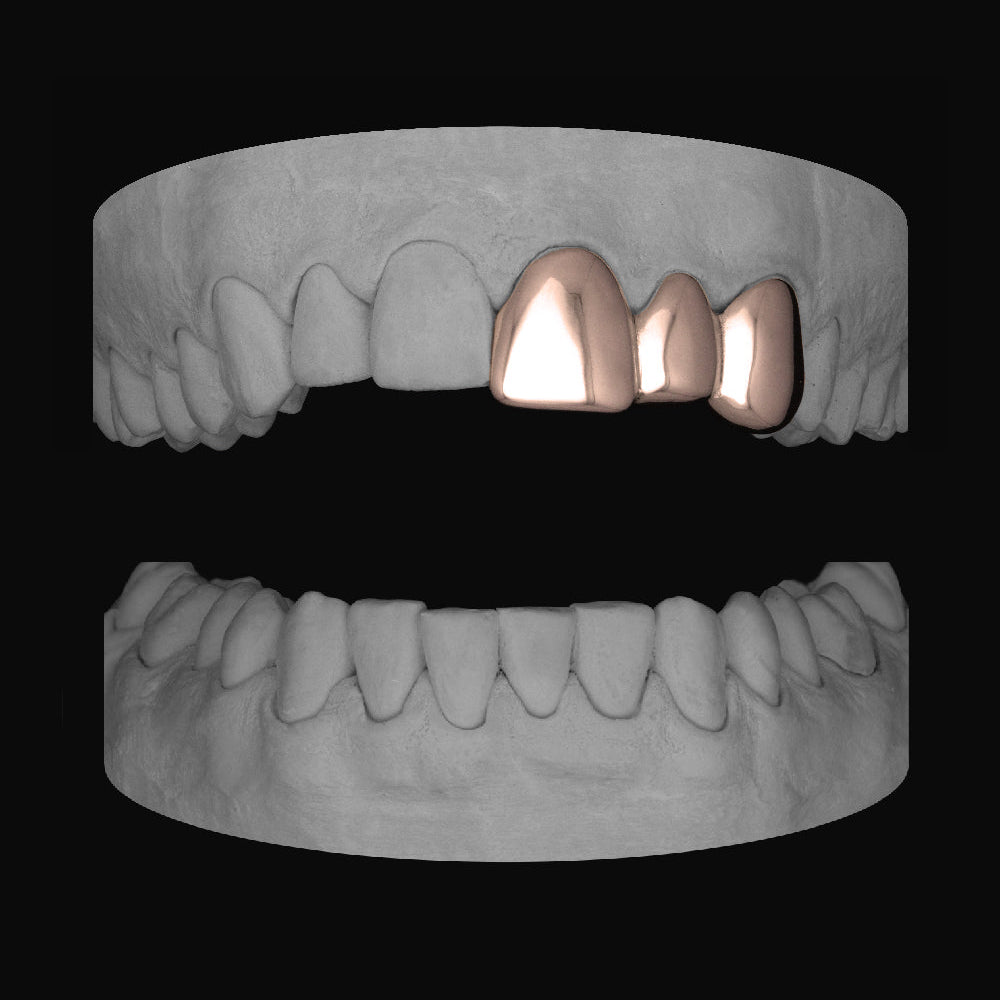 Front & Lateral & Canine - Bitez Grillz