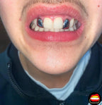 Lateral - Lateral - Bitez Grillz