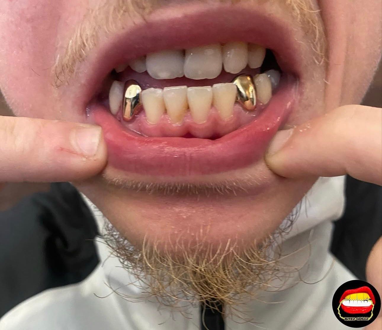 Canine - Canine (Lower) - Bitez Grillz
